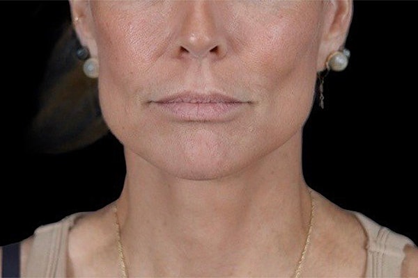 Deep Necklift Before & After