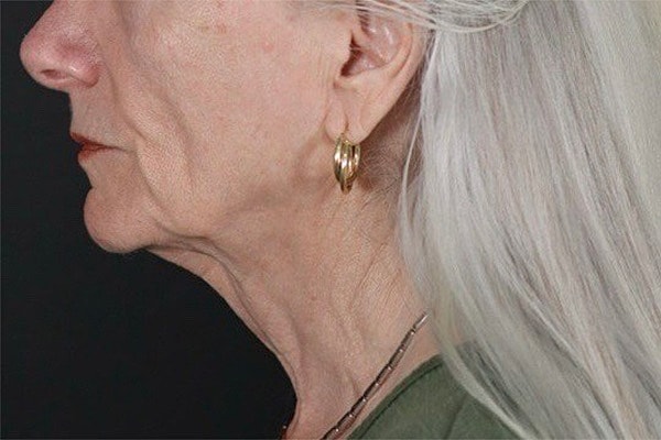 Deep Necklift Before & After