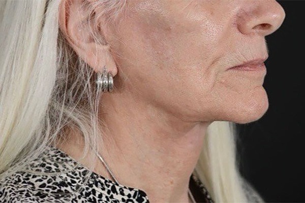 Deep Necklift Before & After