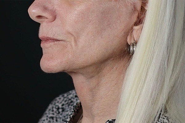 Deep Necklift Before & After