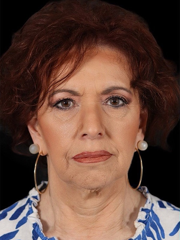 Deep Necklift Before & After