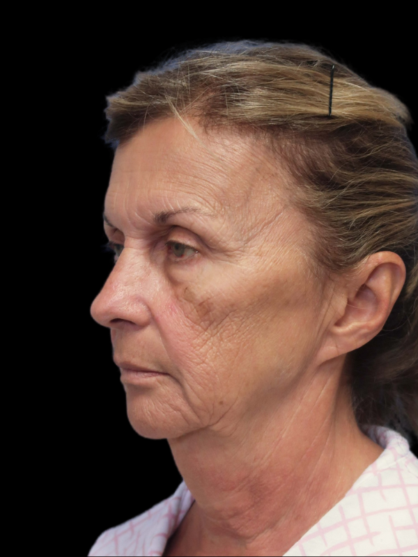 Deep Necklift Before & After