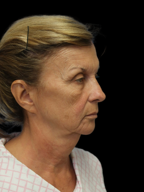 Deep Necklift Before & After