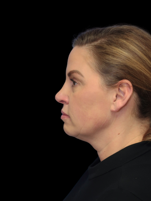 Deep Necklift Before & After