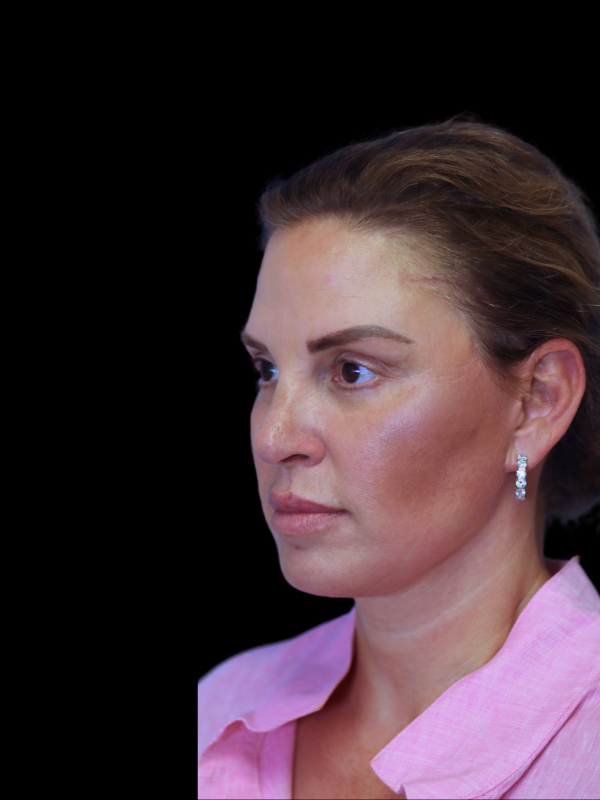 Deep Necklift Before & After