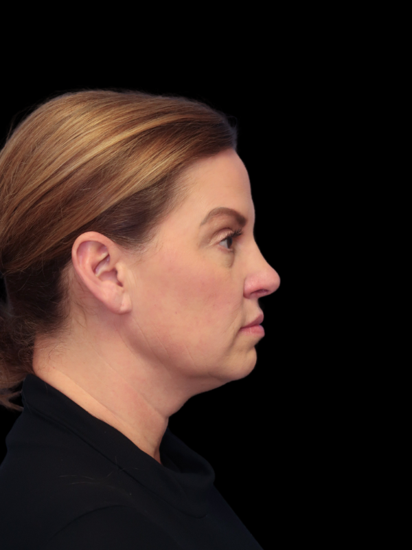 Deep Necklift Before & After