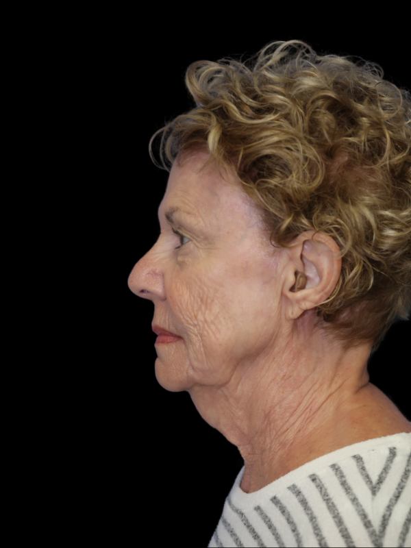 Deep Necklift Before & After