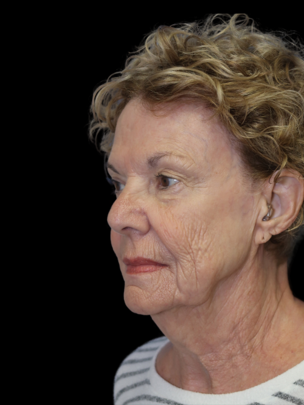 Deep Necklift Before & After