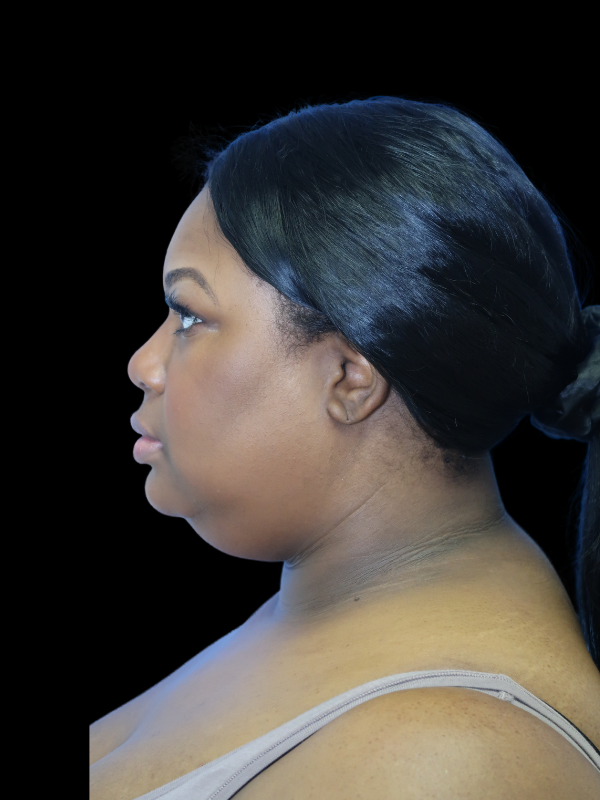 Deep Necklift Before & After