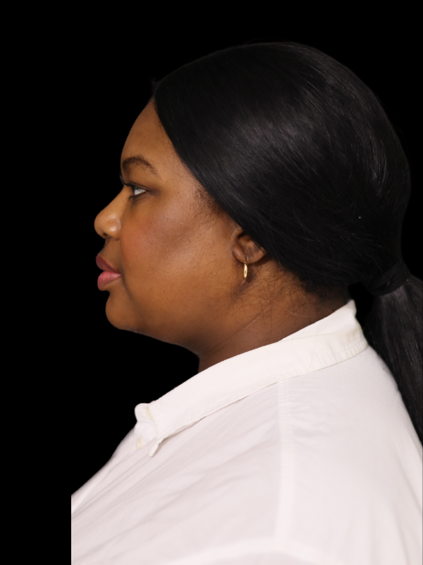 Deep Necklift Before & After