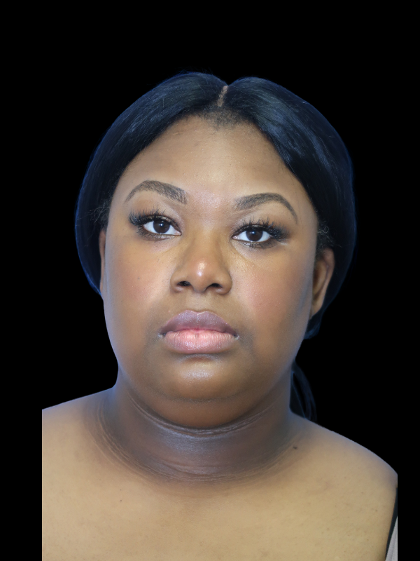 Deep Necklift Before & After