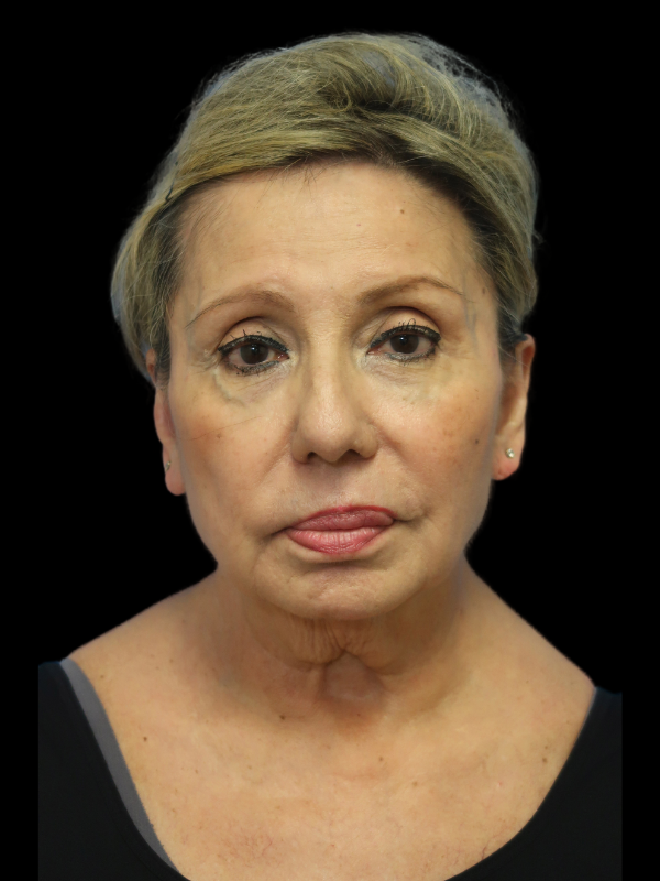 Facelift Neck Lift Before & After