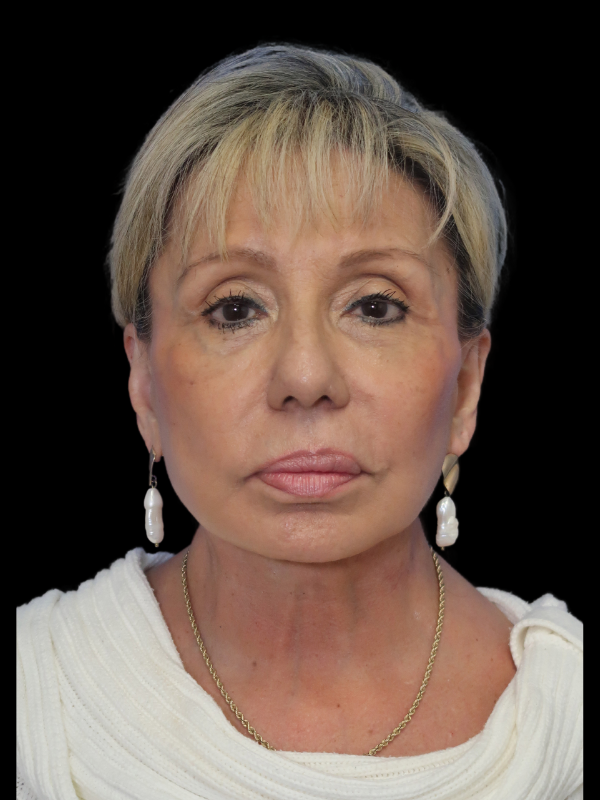 Facelift Neck Lift Before & After