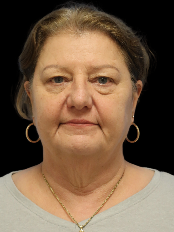 Facelift Neck Lift Before & After