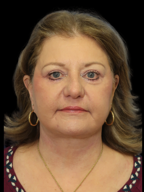 Facelift Neck Lift Before & After