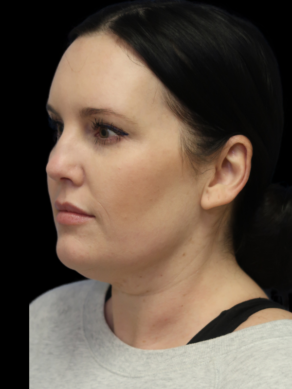 Facelift Neck Lift Before & After