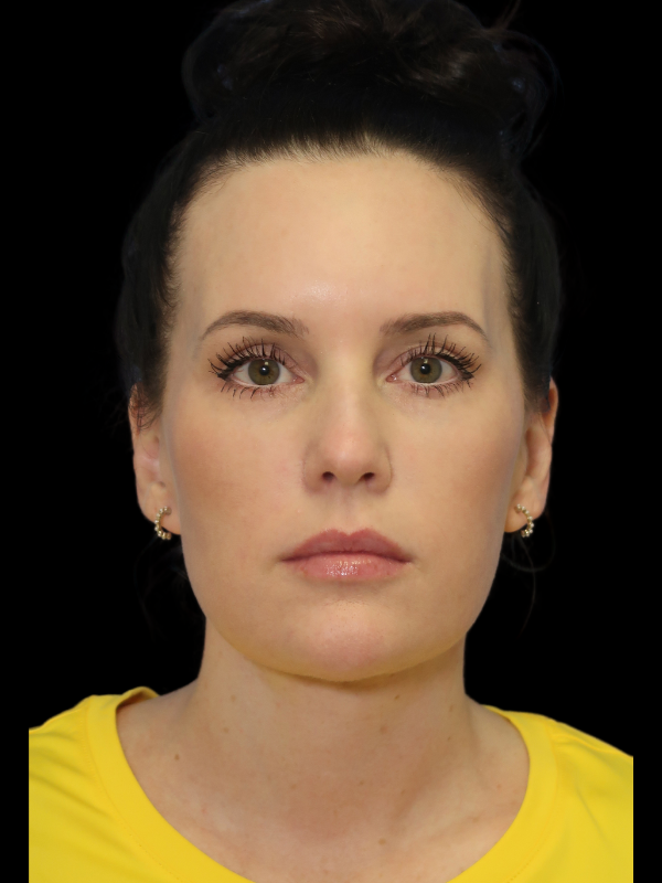 Facelift Neck Lift Before & After