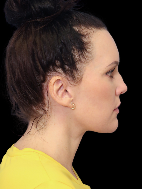 Facelift Neck Lift Before & After