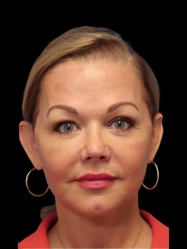 Facelift Neck Lift Before & After