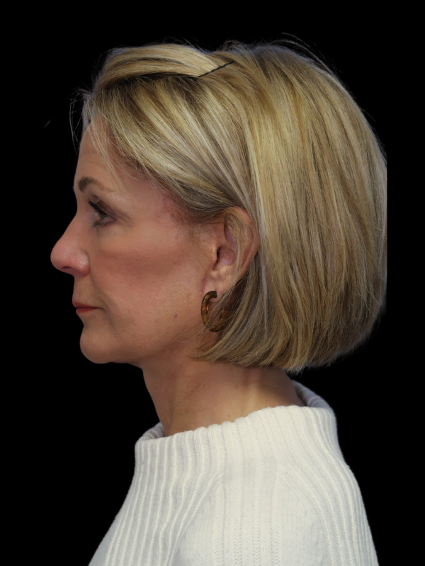 Facelift Neck Lift Before & After