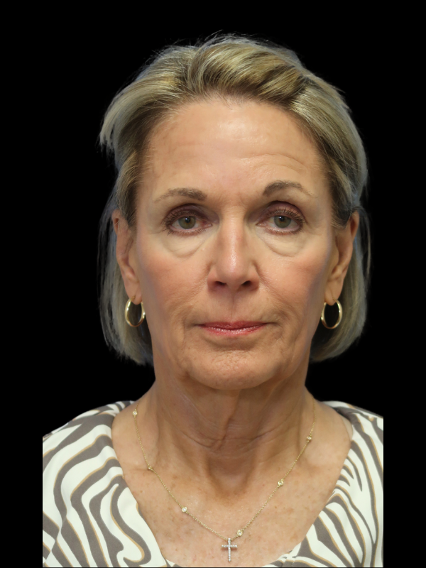Facelift Neck Lift Before & After