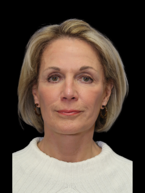 Facelift Neck Lift Before & After