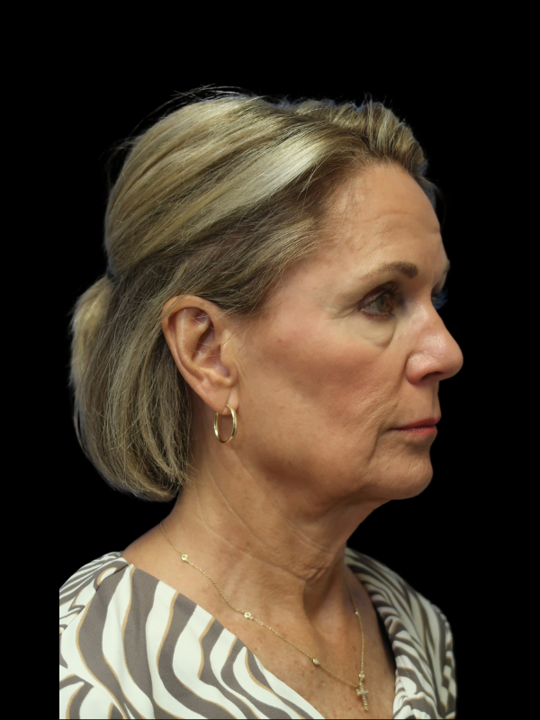 Facelift Neck Lift Before & After