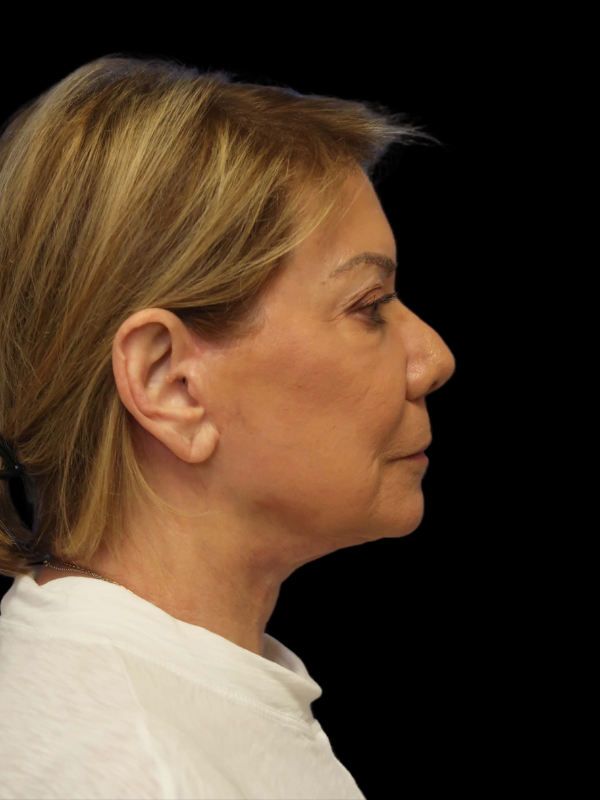 Facelift Neck Lift Before & After