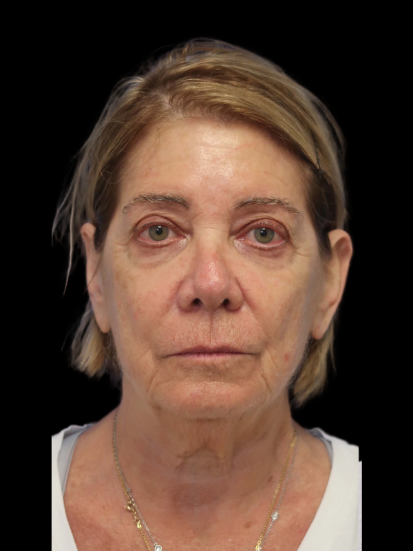 Facelift Neck Lift Before & After