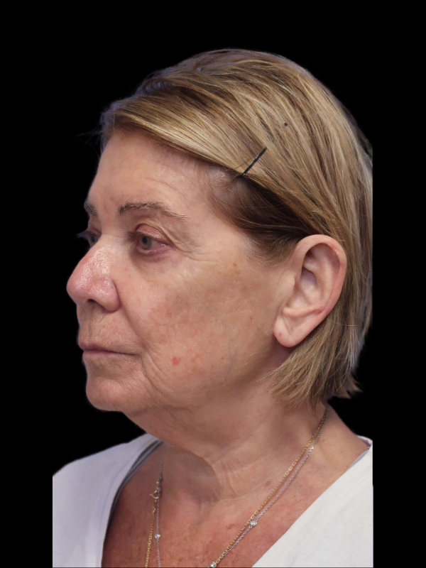 Facelift Neck Lift Before & After