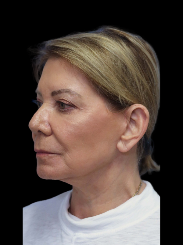 Facelift Neck Lift Before & After