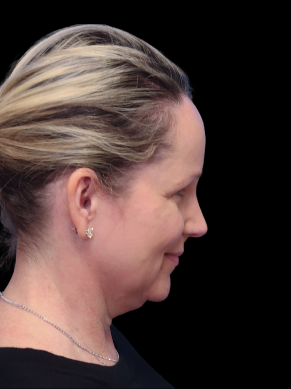 Deep Necklift Before & After