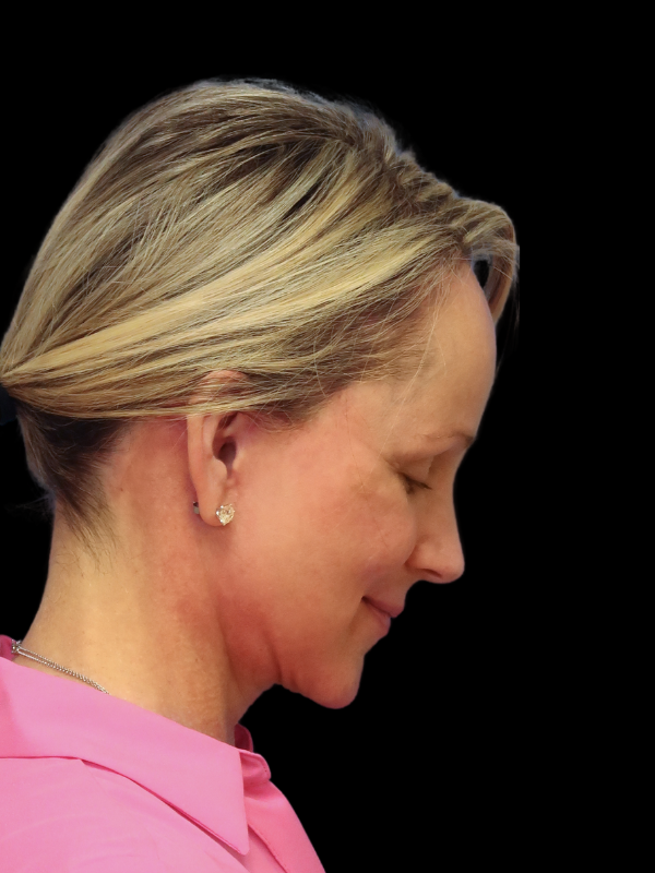 Deep Necklift Before & After