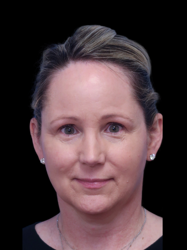 Deep Necklift Before & After