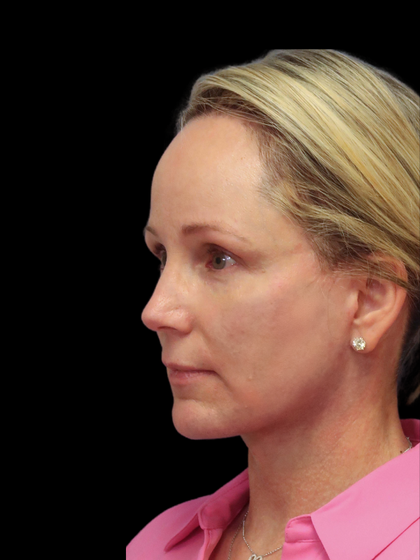 Facelift Neck Lift Before & After