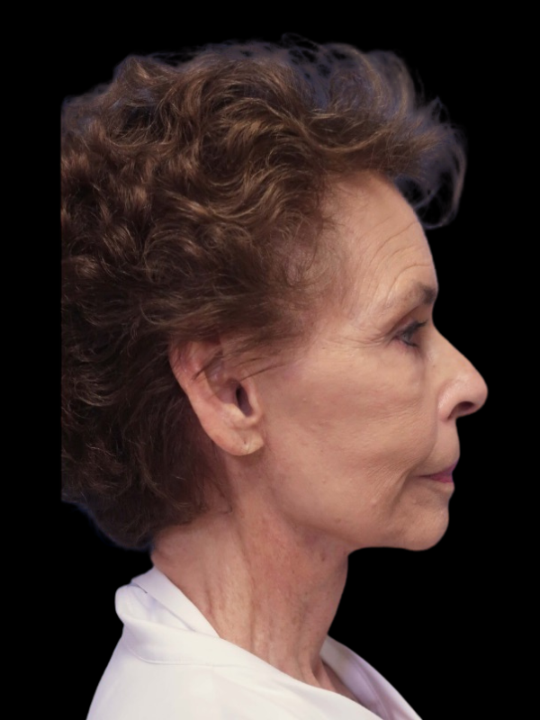 Facelift Neck Lift Before & After