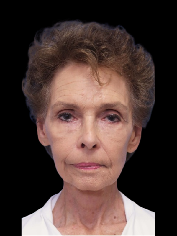 Facelift Neck Lift Before & After