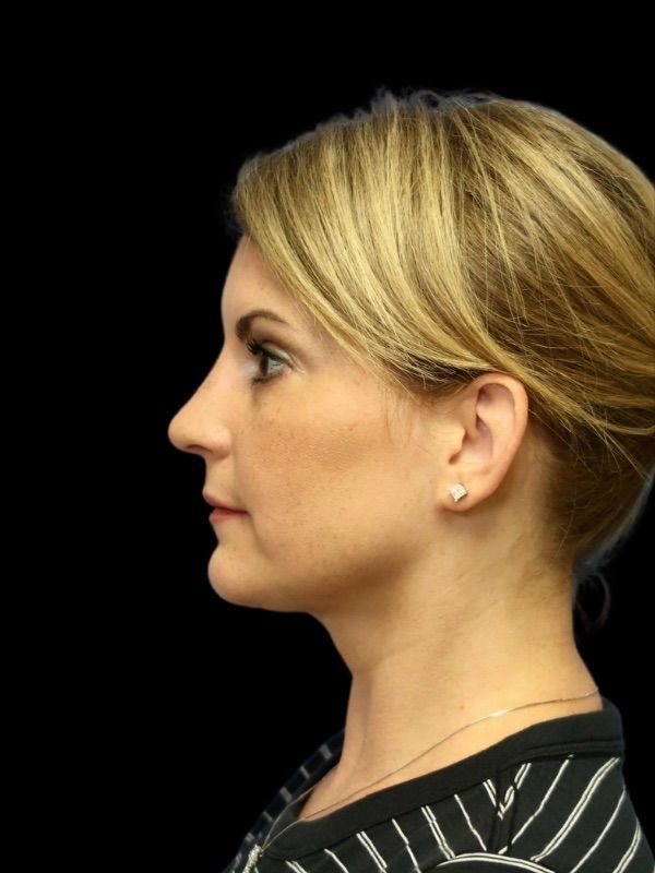 Deep Necklift Before & After