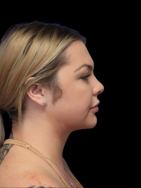 Deep Necklift Before & After