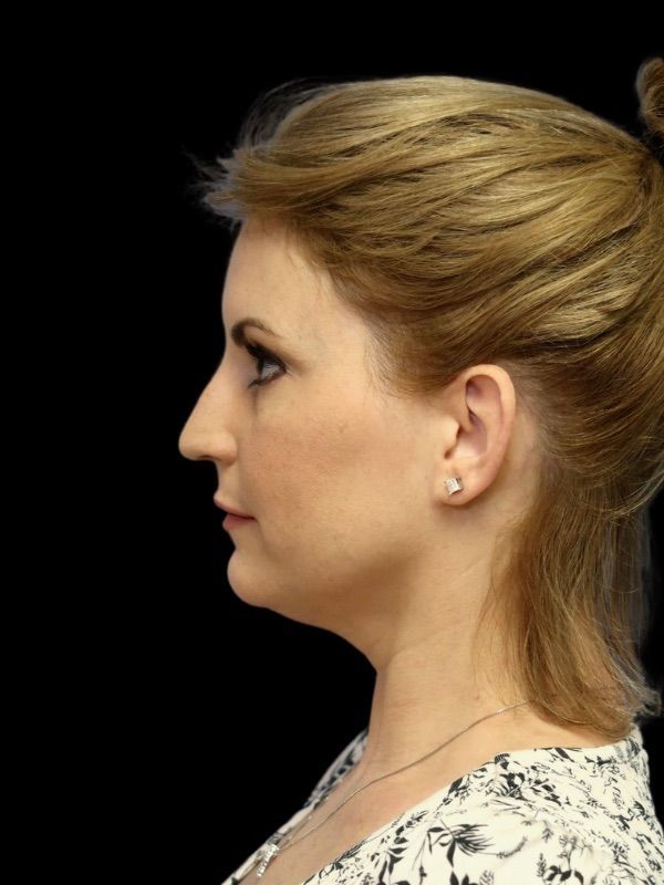 Deep Necklift Before & After