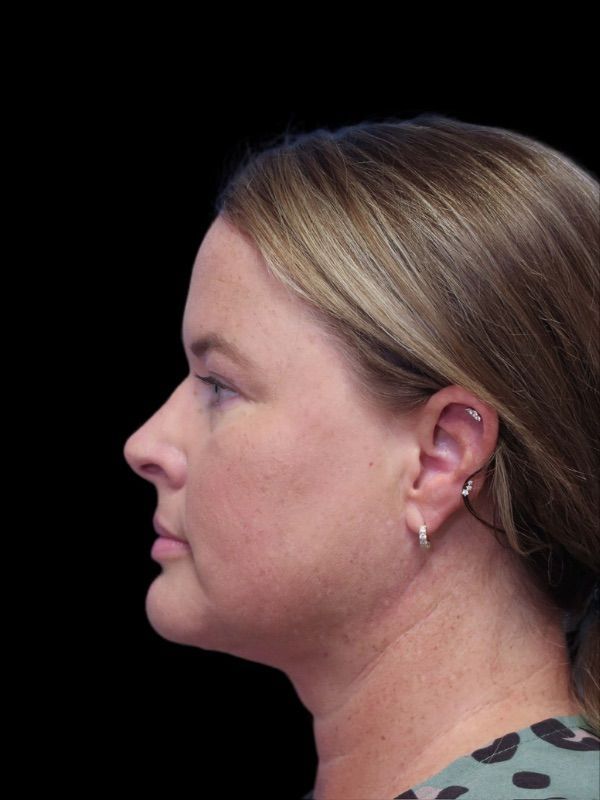 Deep Necklift Before & After