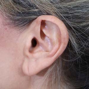 Earlobe Reduction Before & After