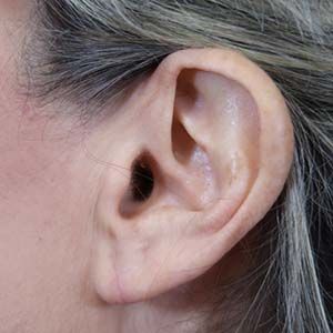 Earlobe Reduction Before & After