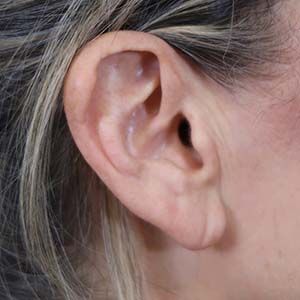 Earlobe Reduction Before & After