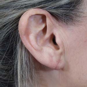 Earlobe Reduction Before & After