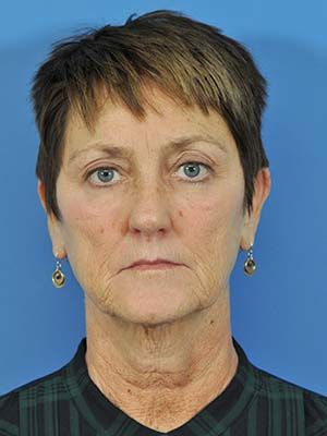 Sculptra Before & After