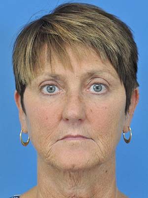 Sculptra Before & After