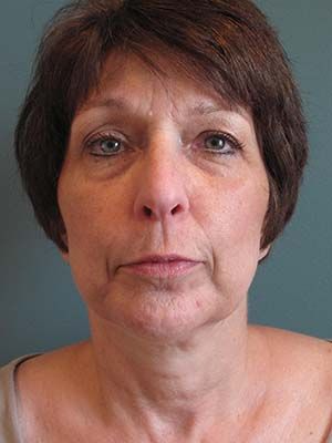 Sculptra Before & After