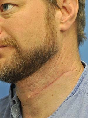 Scar Treatment Before & After