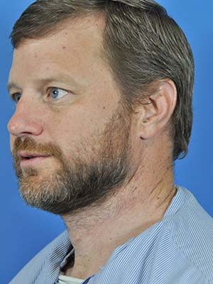 Scar Treatment Before & After